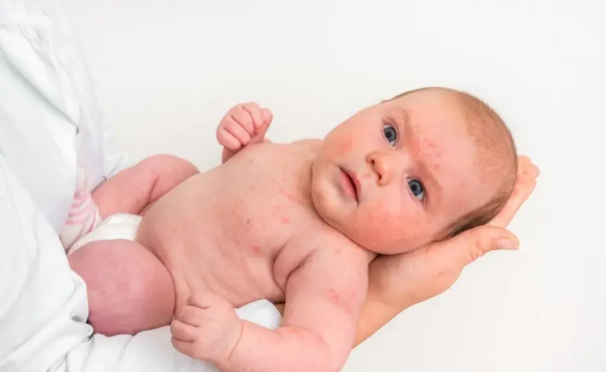 Alergia al huevo en bebés - síntomas y cómo actuar