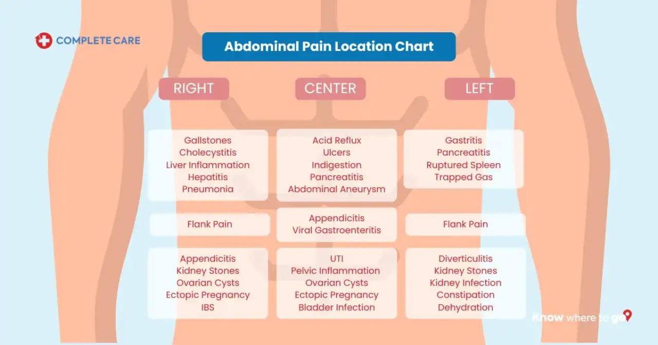 Mapa de dolor abdominal. El ardor de estómago puede ser un síntoma de reflujo ácido o indigestión en el centro.