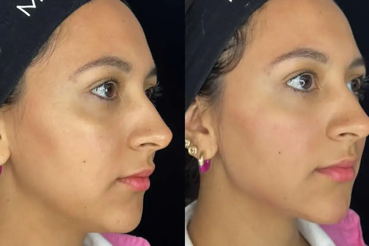 Comparaci&oacute;n antes y despu&eacute;s de un tratamiento para tomar &aacute;cido hialur&oacute;nico, mostrando un rostro m&aacute;s relleno y definido.