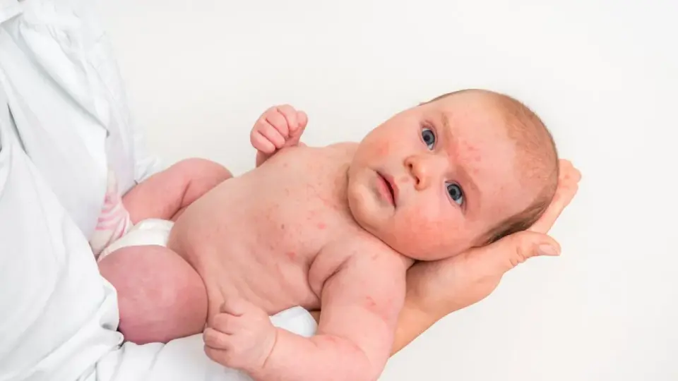 Alergia al huevo en bebés - síntomas y cómo actuar